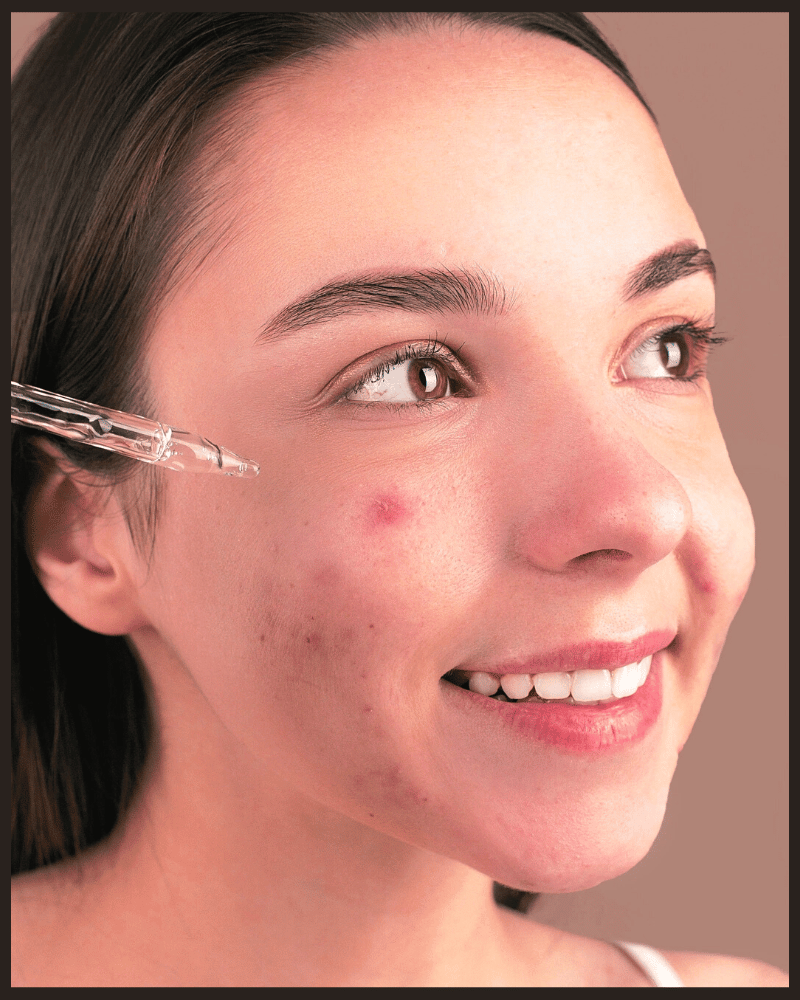 is hyaluronic acid good for acne