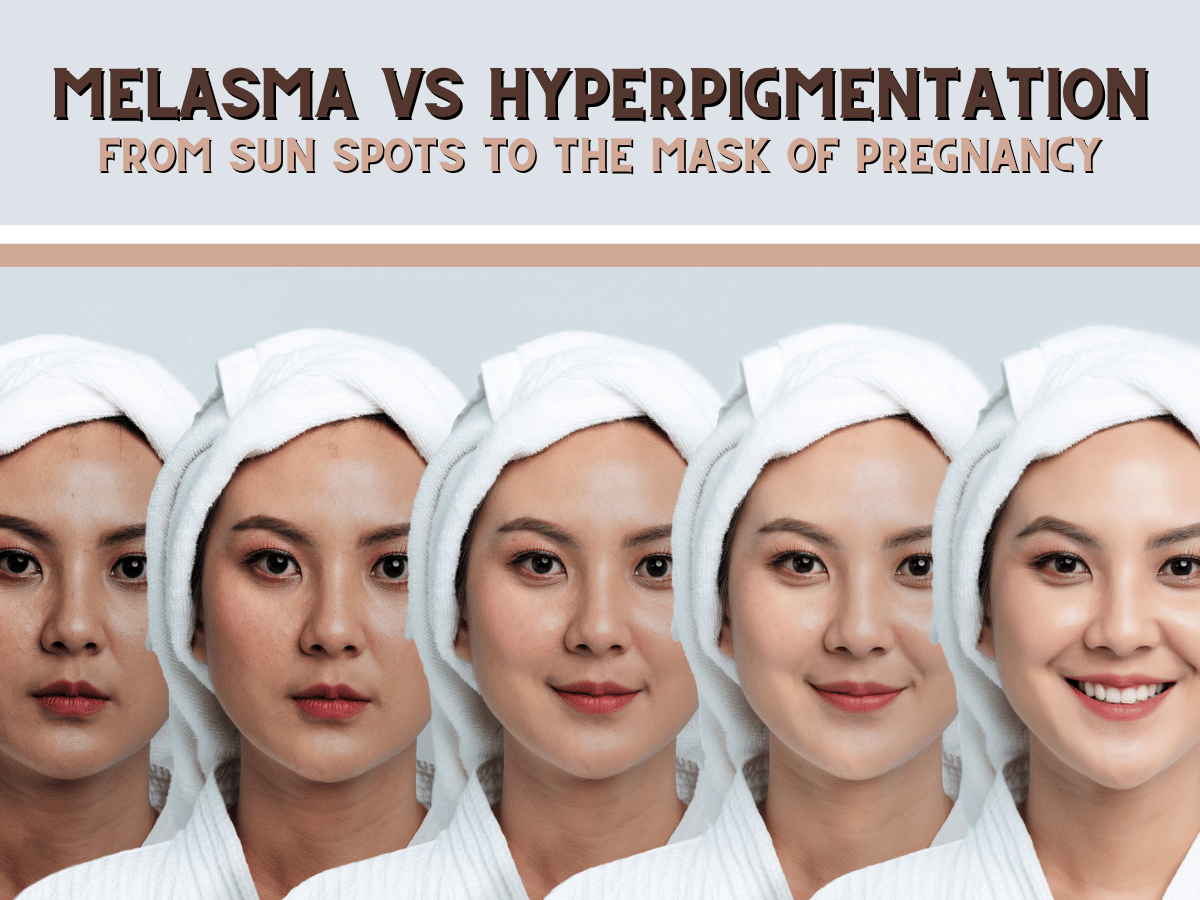 Melasma vs Hyperpigmentation: From Sun Spots to the Mask of Pregnancy