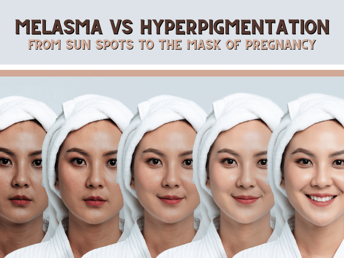 Melasma vs Hyperpigmentation: Differences & Treatments | Elite Selects